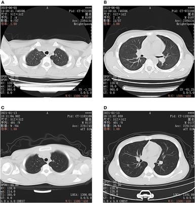 Case Report: Primary Bilateral Minimally Invasive Adenocarcinoma of the Lungs in an 11-Year-Old Child: A Rare Case